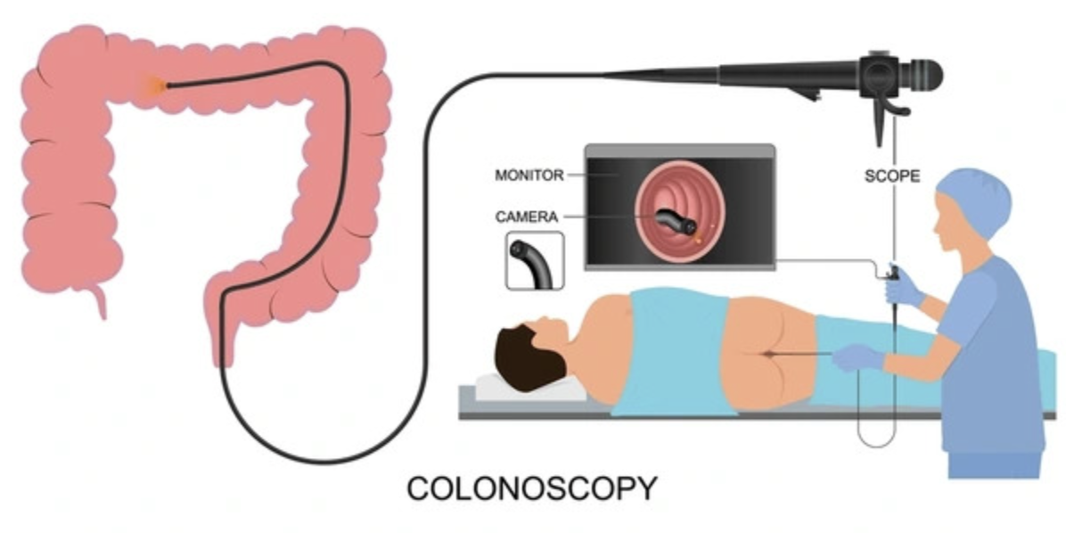 Colonoscopy Graphic
