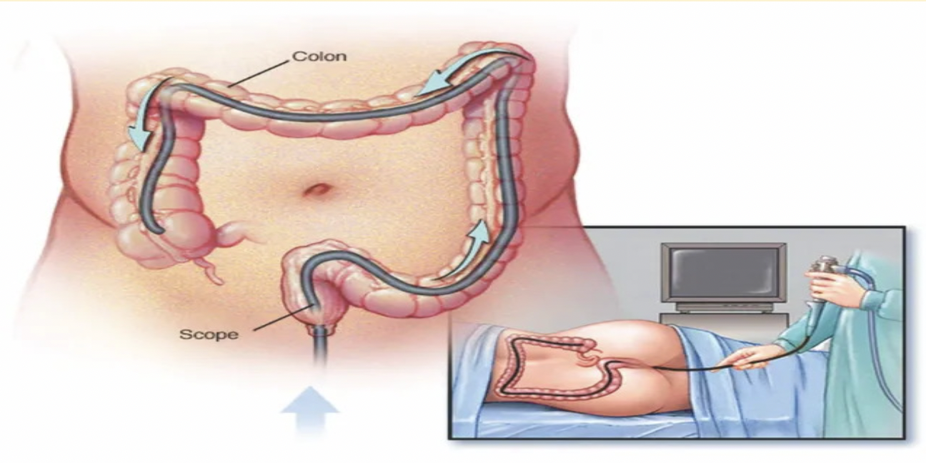Colonoscopy Procedure Graphic
