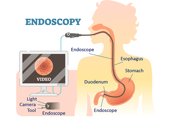 Endoscopy procedure illustration