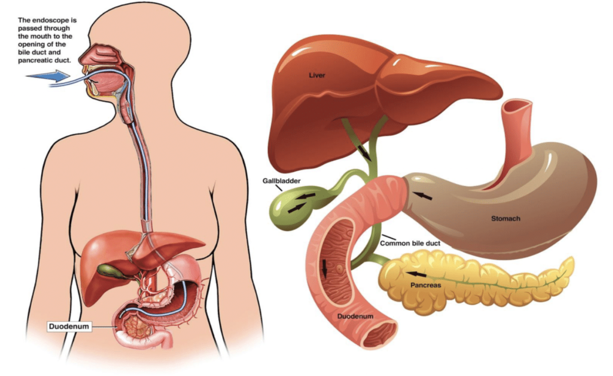 ERCP Graphic