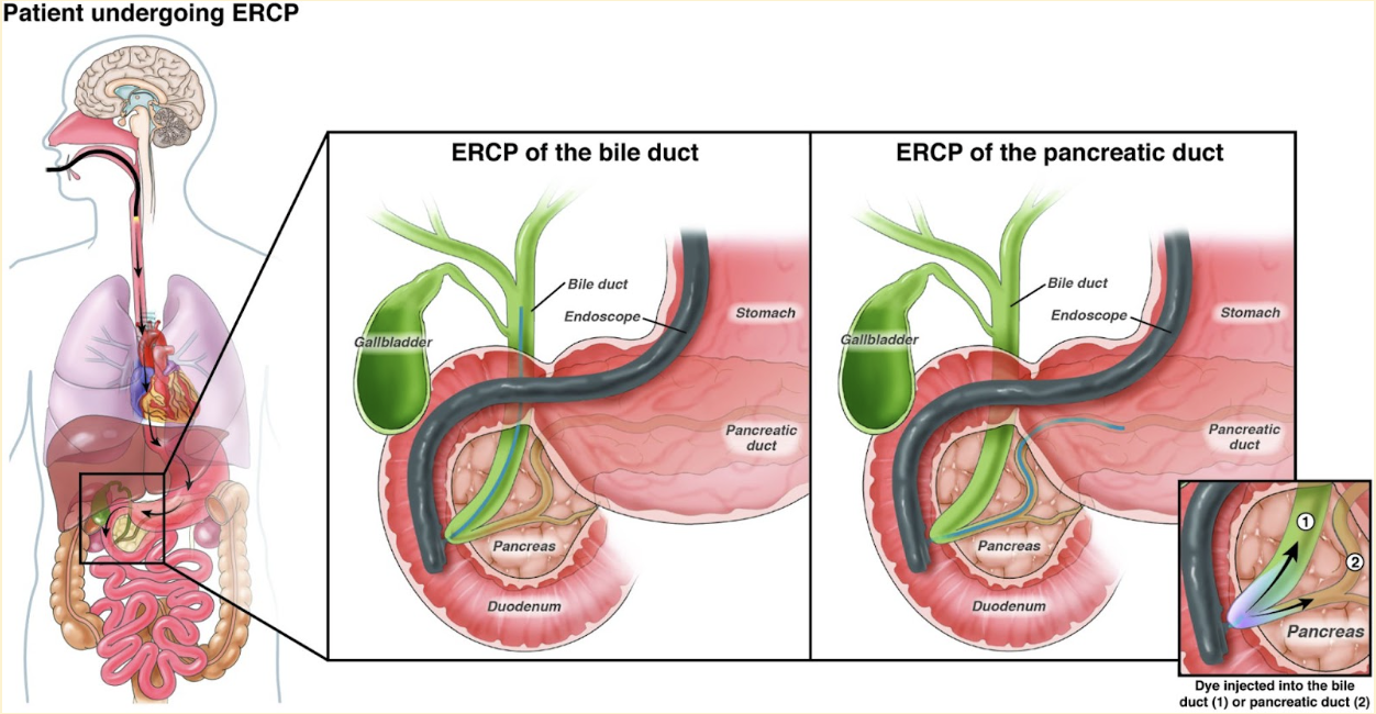 ERCP procedure graphic