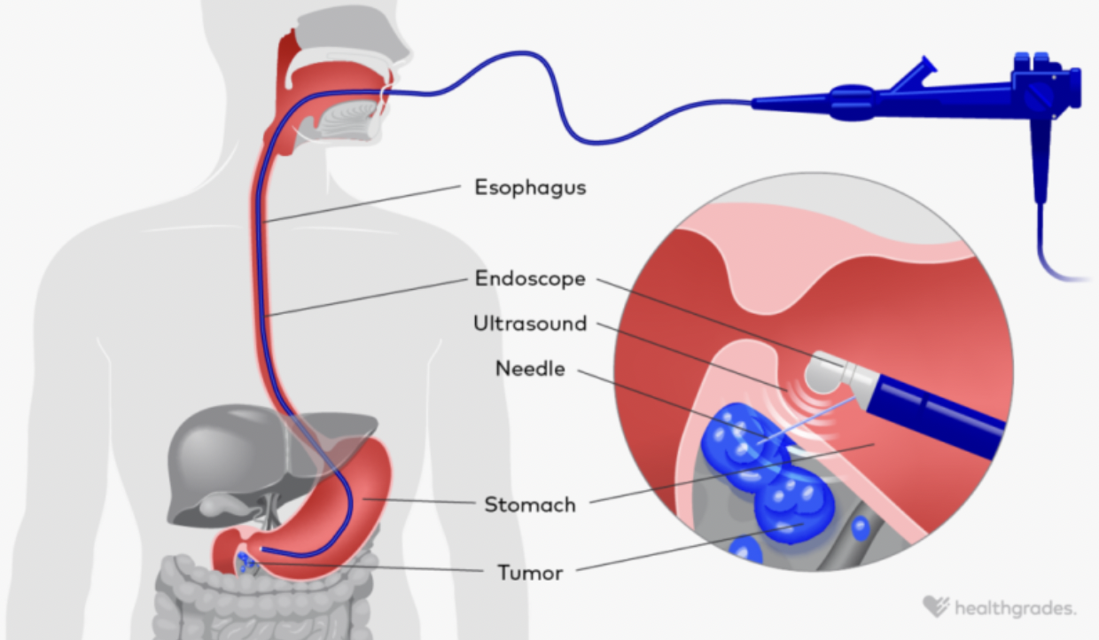 EUS procedure graphic