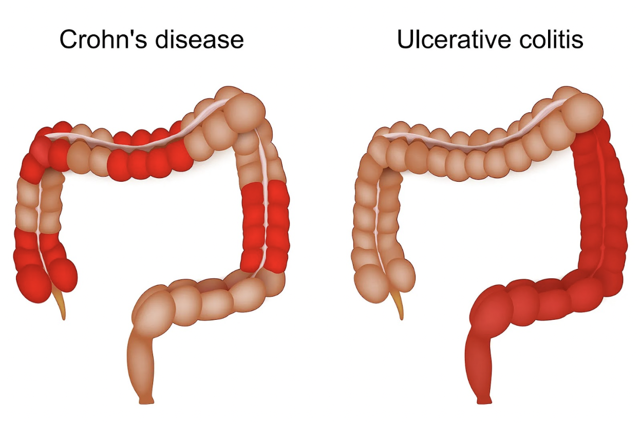 IBD Graphic