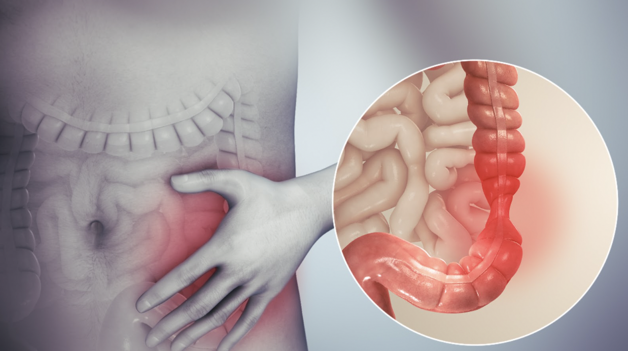 IBS Graphic