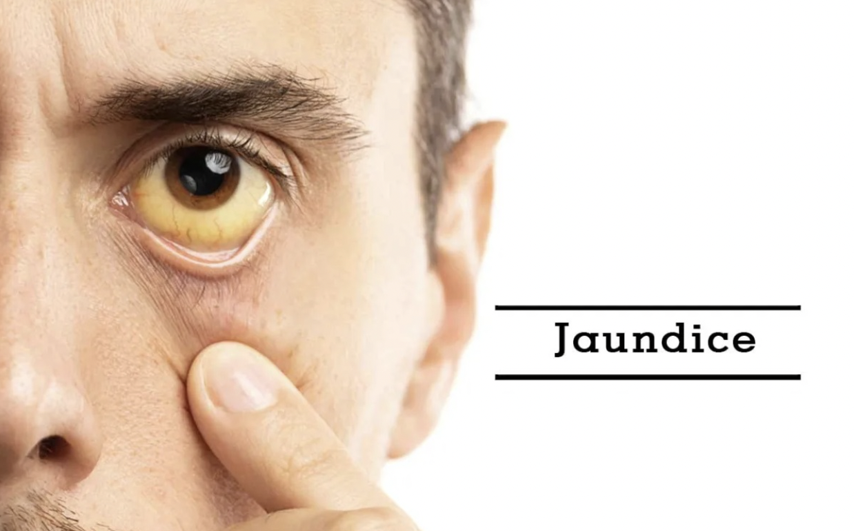 Jaundice Graphic