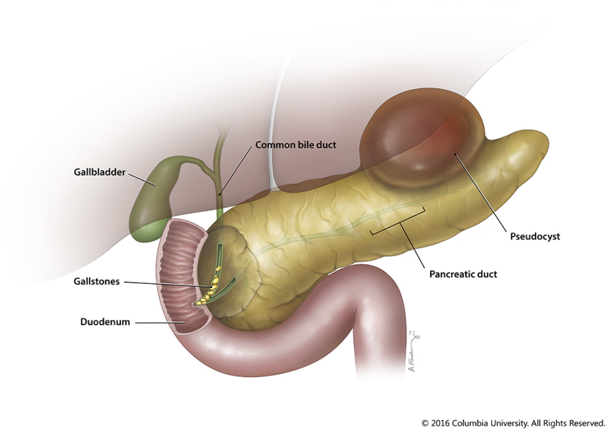 Pancreatitis Graphic