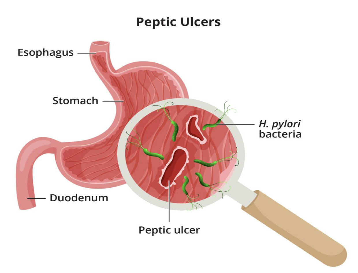 Ulcer Graphic